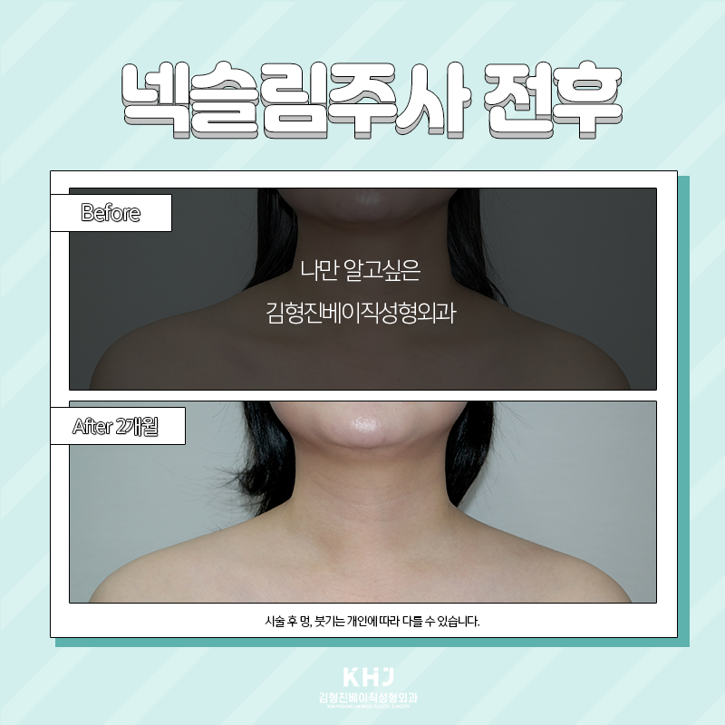 웨딩시술 뭐해야 할지 고민되셨다면? 관련 이미지 5