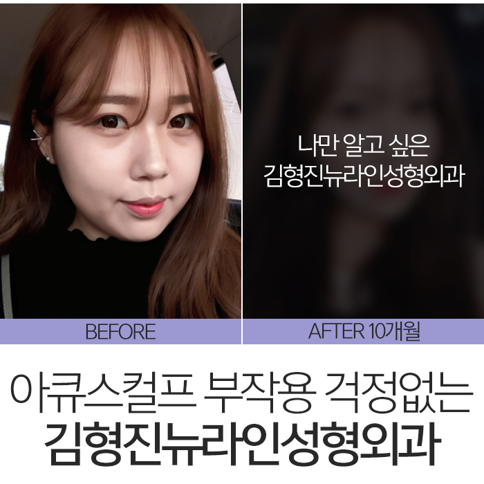 아큐스컬프부작용 걱정된다면 관련 이미지 3
