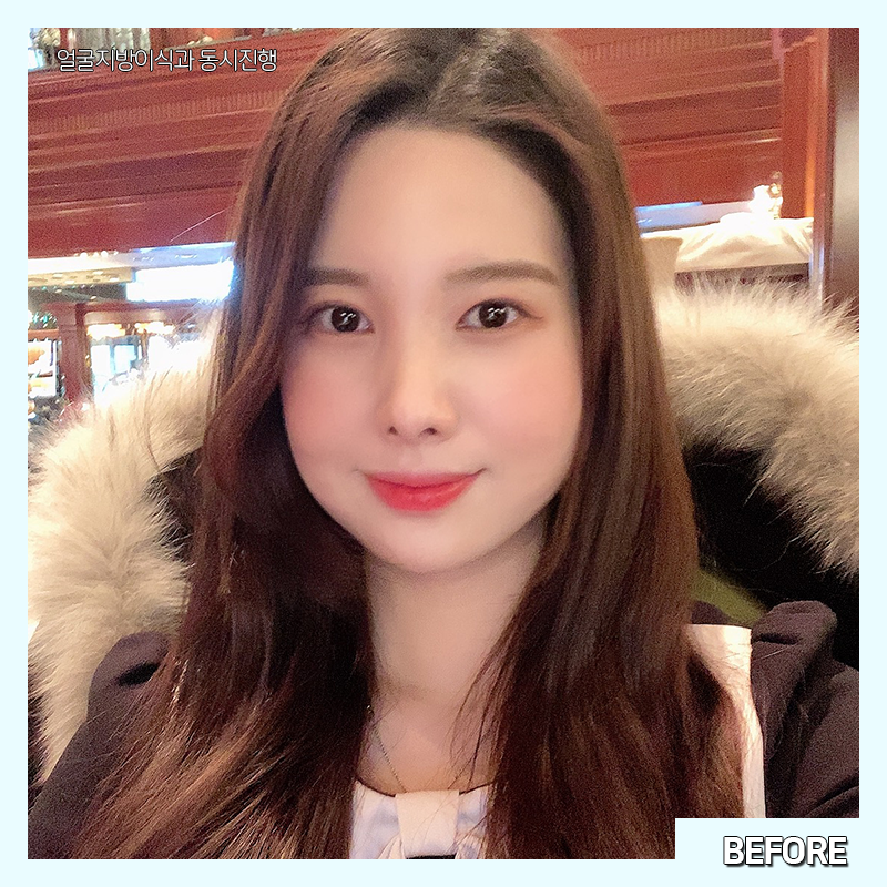 얼굴지흡효과 얼마나 좋냐면요 관련 이미지 2