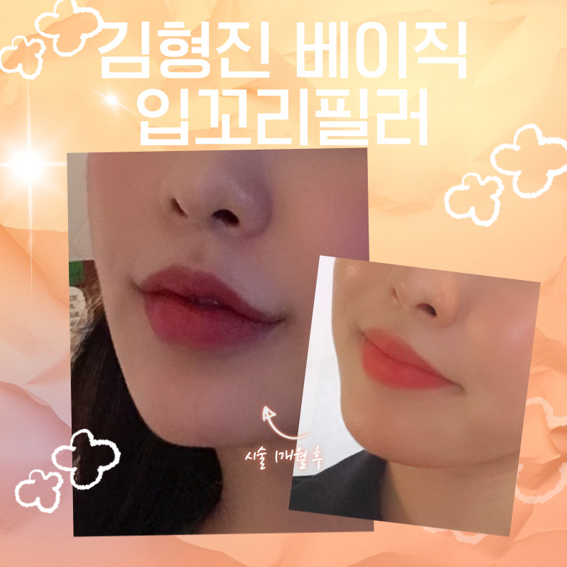 강남입꼬리필러추천 부드럽고 생기 있는 미소 만들기 관련 이미지 4