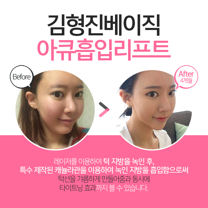 턱선지방흡입 김형진베이직성형외과 짜란다 관련 이미지 4