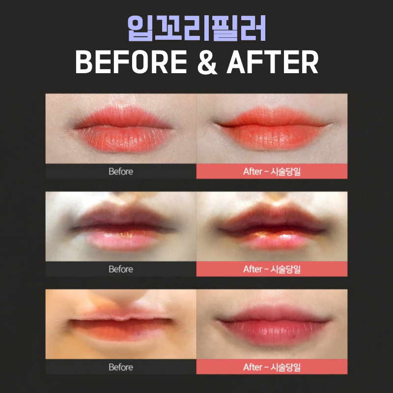 입꼬리필러잘하는곳에서 입꼬리부터 인상까지 밝게! 관련 이미지 5