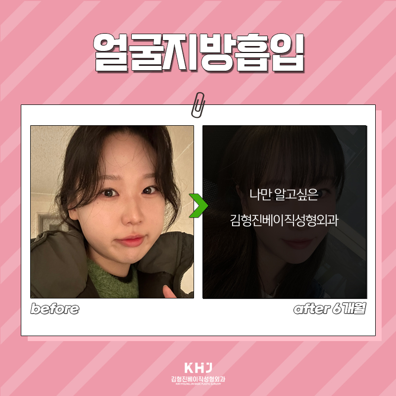 얼굴지방흡입효과 확실한 차이 보고가세요! 관련 이미지 4