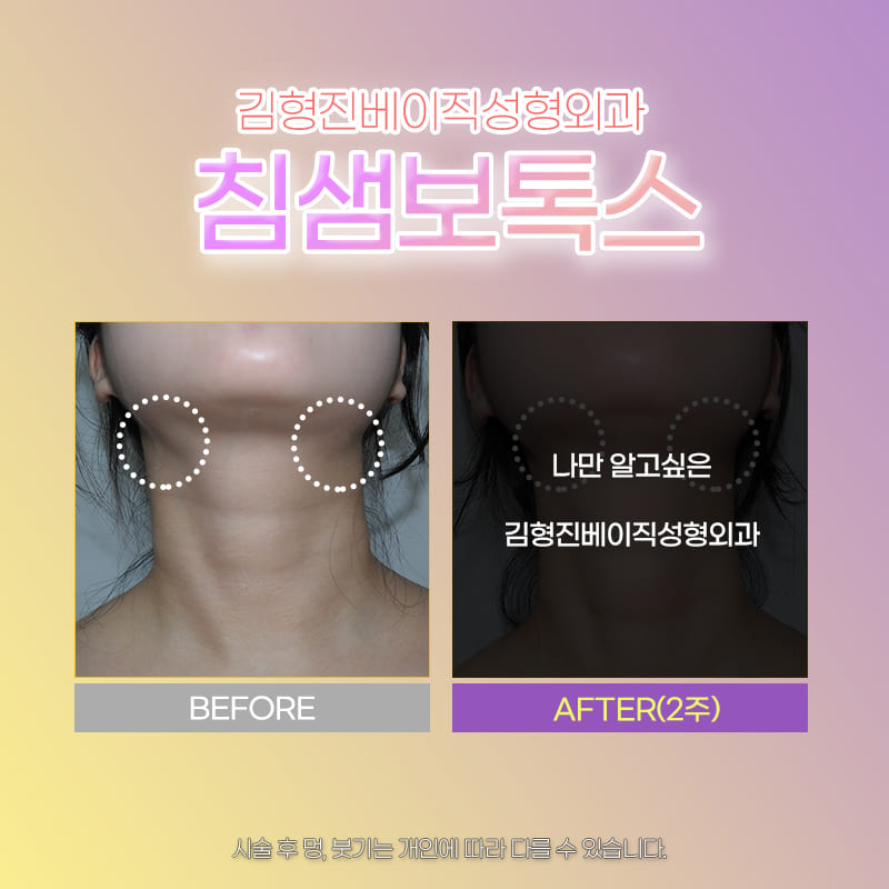 얼굴 가로길이 줄여주는 침샘보톡스시술 관련 이미지 5
