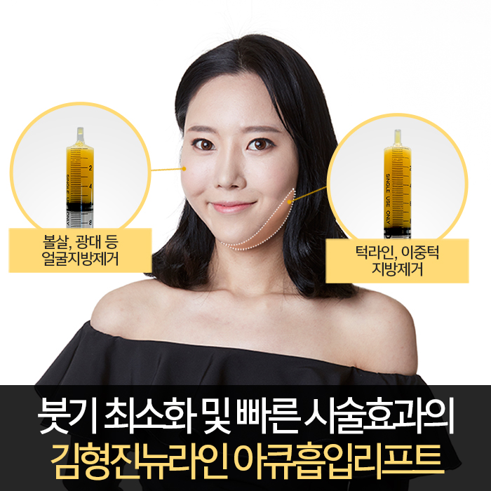 광대지방흡입 김형진뉴라인성형외과지 관련 이미지 5