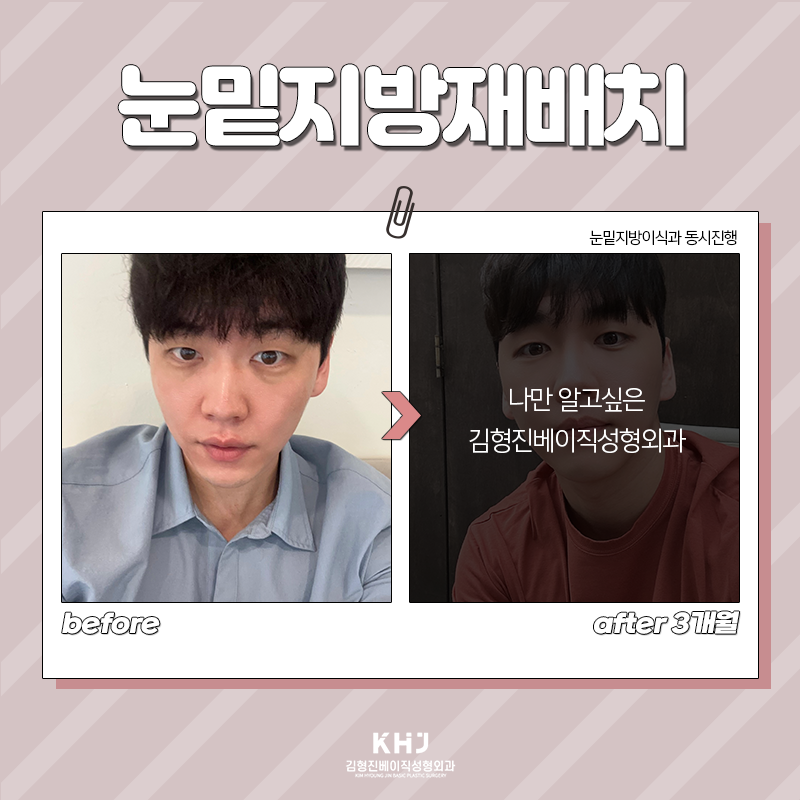 Take a look at the before-and-after of under-eye fat repositioning! image 3