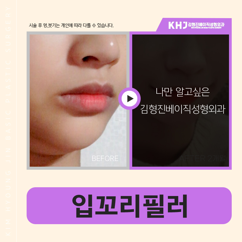 드디어 남자입꼬리필러도 잘하는 곳 찾았어요! 관련 이미지 5