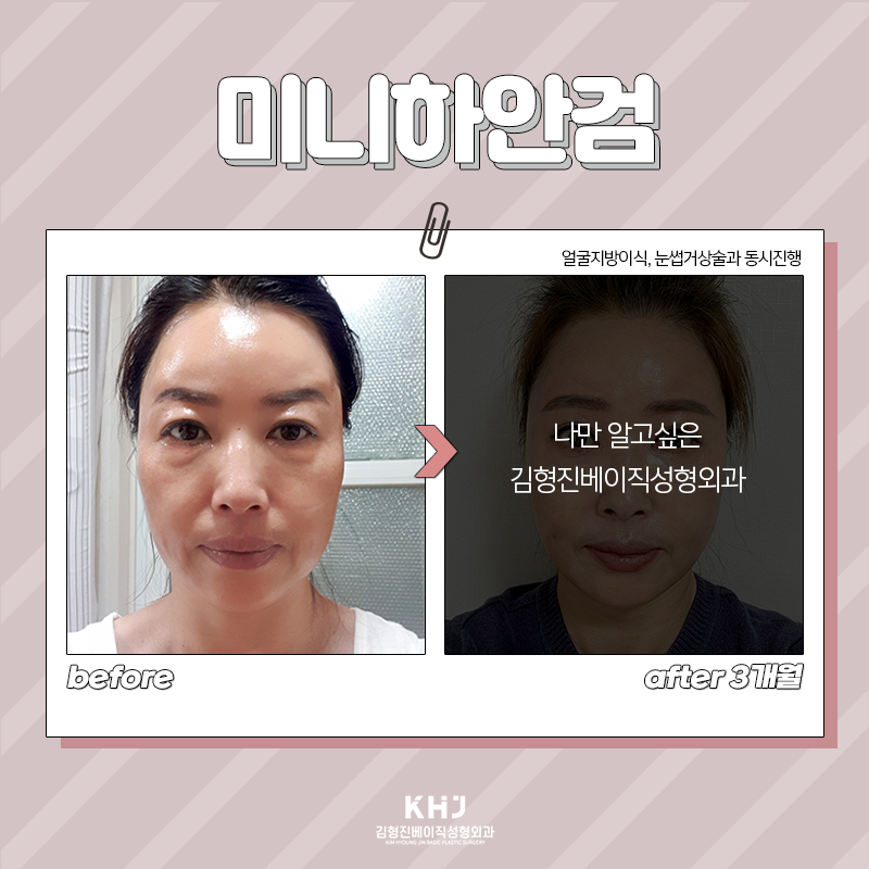 미니하안검절개 걱정은 이제 그만! 관련 이미지 4
