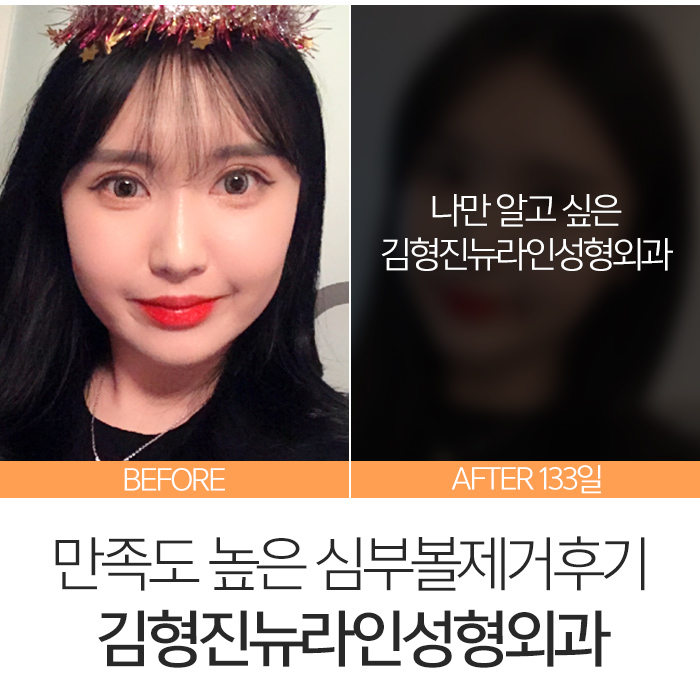 심부볼제거후기 내 맘에 아주 쏙 들어 관련 이미지 8