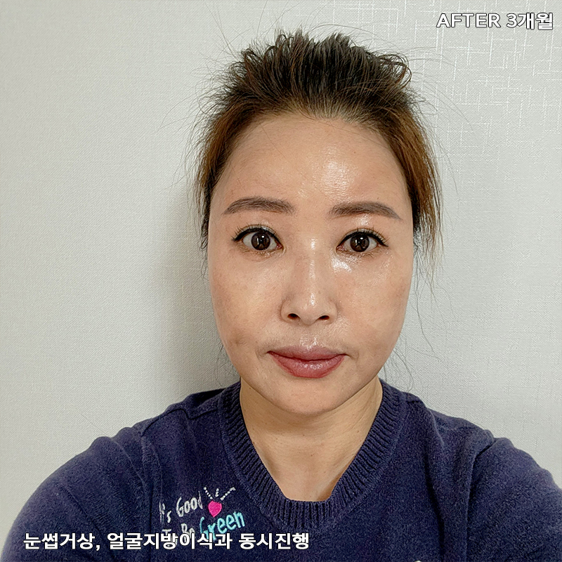 중년눈밑지방개선 어떤 방법이 있냐구요? 관련 이미지 5