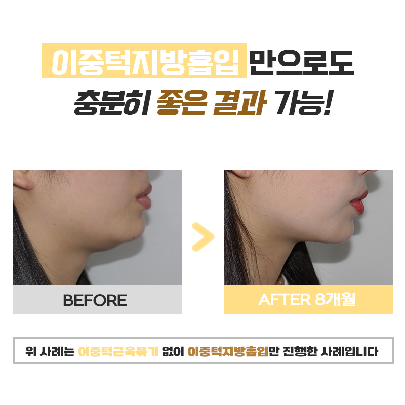 턱선을 되살리는 이중턱살빼는법, 궁금하신가요? 관련 이미지 4