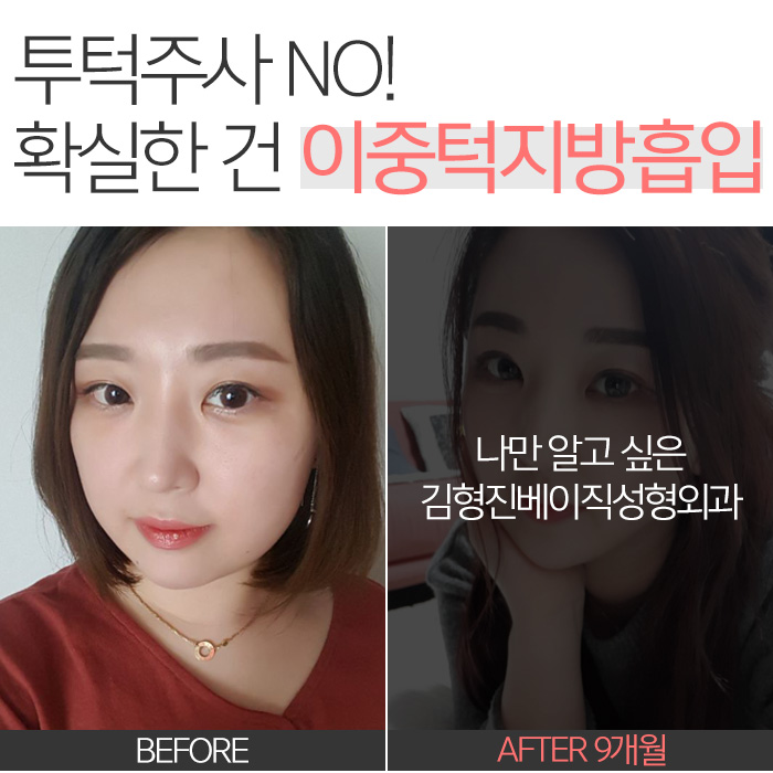 투턱주사 언제까지 맞으려구요? 관련 이미지 3