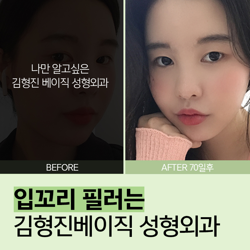 입꼬리필러 맞고 웃상얼굴 되어보기 관련 이미지 2
