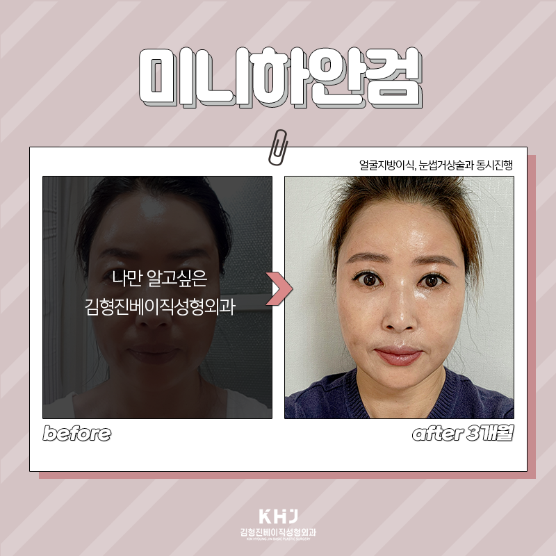 미니하안검절개 걱정은 이제 그만! 관련 이미지 5