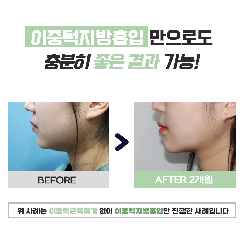 이중턱살빼는방법 김형진베이직에선 어렵지 않습니다 관련 이미지 7