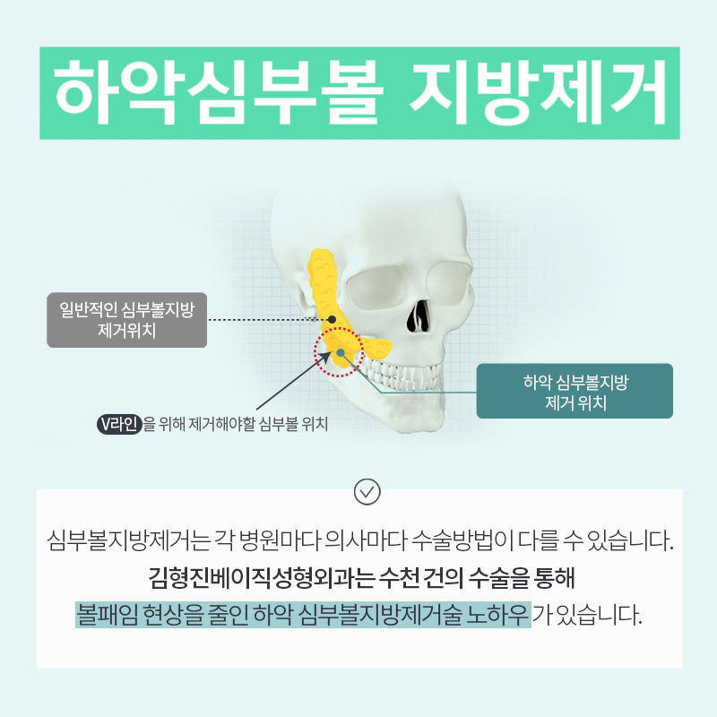 얼굴지방흡입 받고 이미지 변신 제대로 했어요 관련 이미지 5