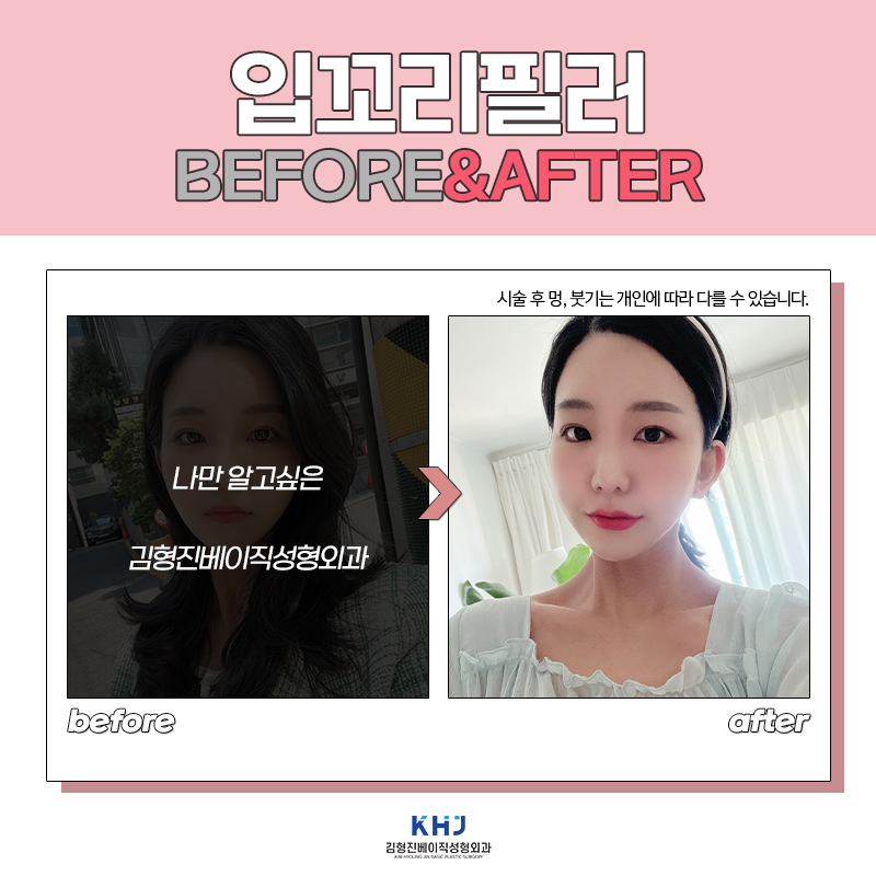 입꼬리필러전후 보고 가실래요? 관련 이미지 4