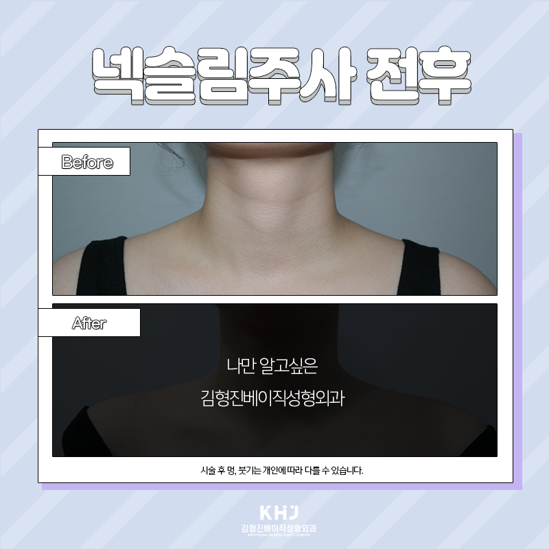 넥슬림주사전후 당연히 보여드려야죠! 관련 이미지 2