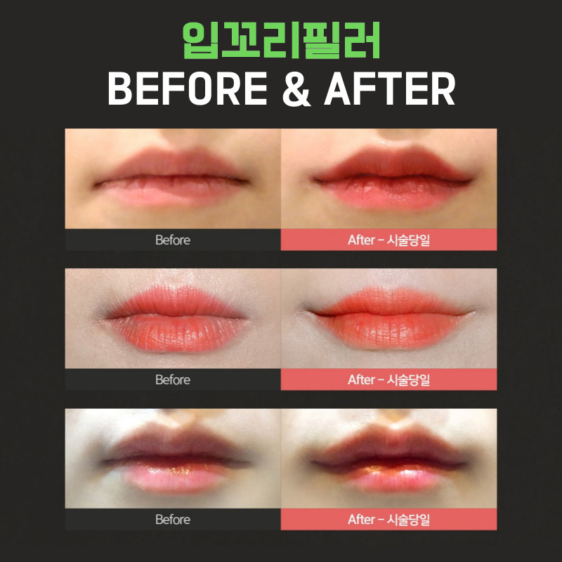 만족도 높은 입꼬리필러시술 여기에요 여기! 관련 이미지 6