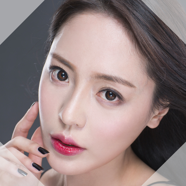 레이저눈밑지방재배치 흉터없이 완벽하게! 관련 이미지 2