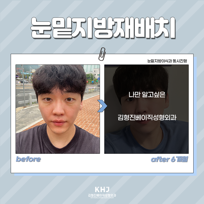 눈밑재수술 걱정 덜어놓으셔도 되는 이유 관련 이미지 5
