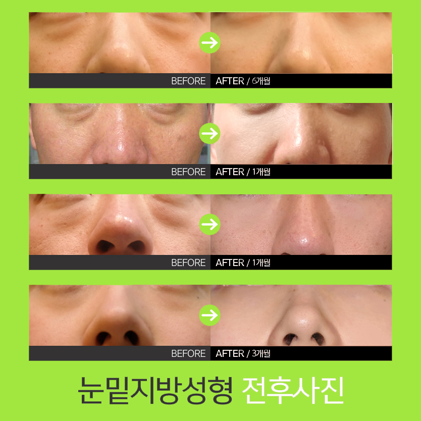 눈밑지방수술 했더니 인상까지 좋아졌어요! 관련 이미지 6
