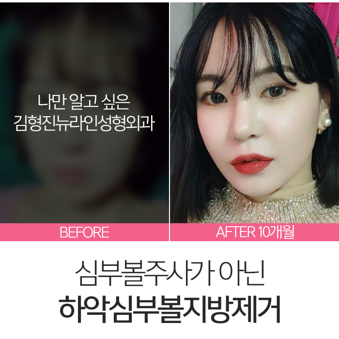 심부볼주사 이걸론 절대 못 빼요 관련 이미지 7
