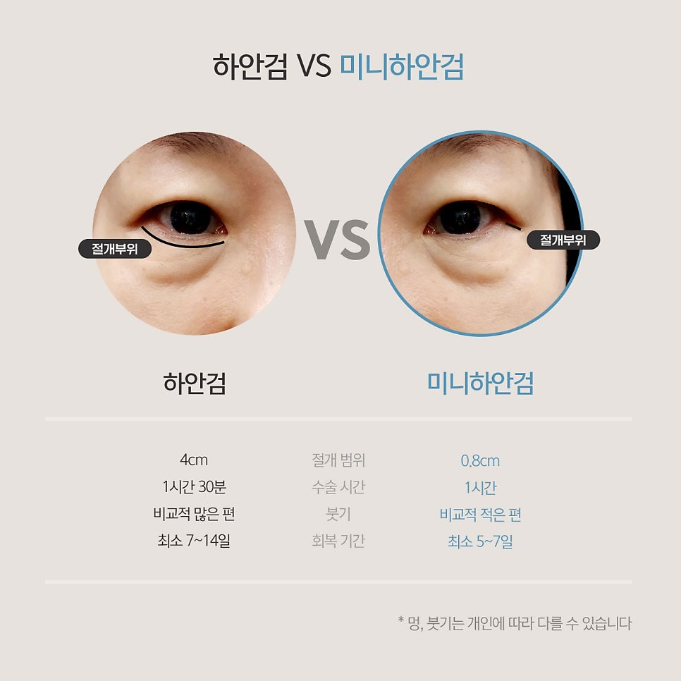 중년눈밑처짐 잃어버린 10년 찾아드렸어요! 관련 이미지 4