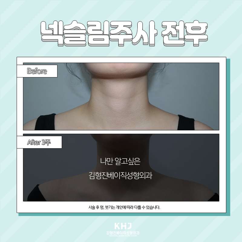 웨딩관리 김형진베이직에서 해야하는 이유 관련 이미지 2