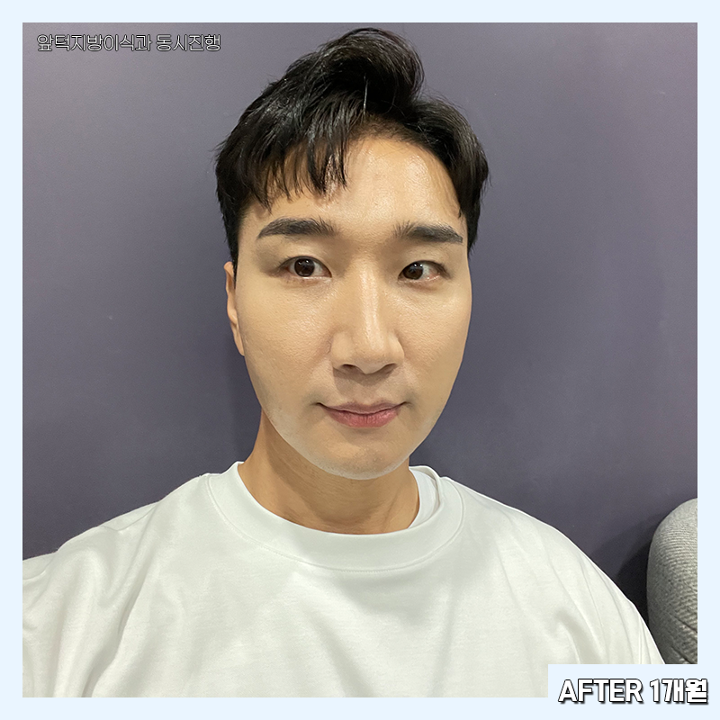 남자심부볼제거 가능하냐구요? 당연하죠! 관련 이미지 5