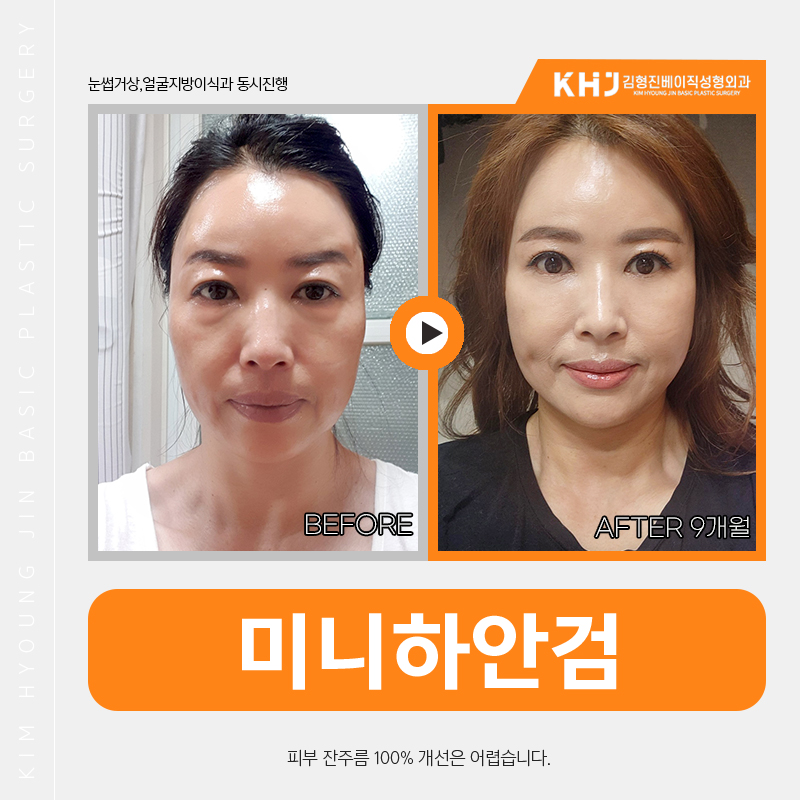 중년눈수술전후 잘하는 병원 알아보는 중이라면 관련 이미지 5