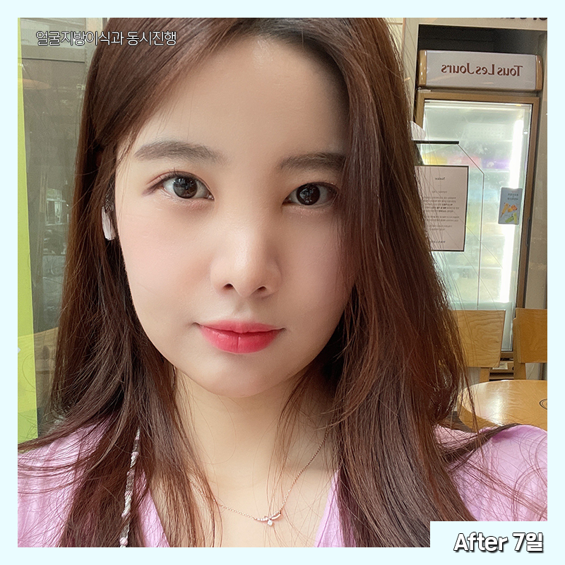 얼굴지흡효과 얼마나 좋냐면요 관련 이미지 4