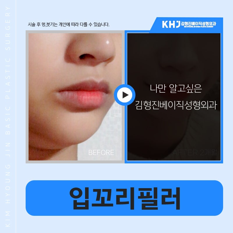 압구정입꼬리필러후기 이만큼 만족스러울 수가 없어요 관련 이미지 5