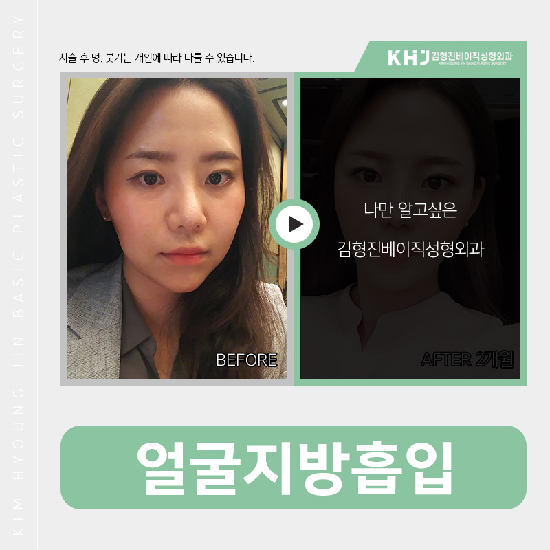 얼굴지방흡입부작용 없는 이유? 관련 이미지 3