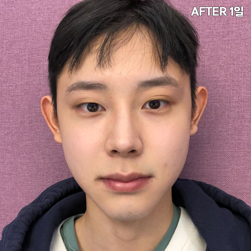 남자심부볼제거? 당연히 가능하죠! 관련 이미지 3