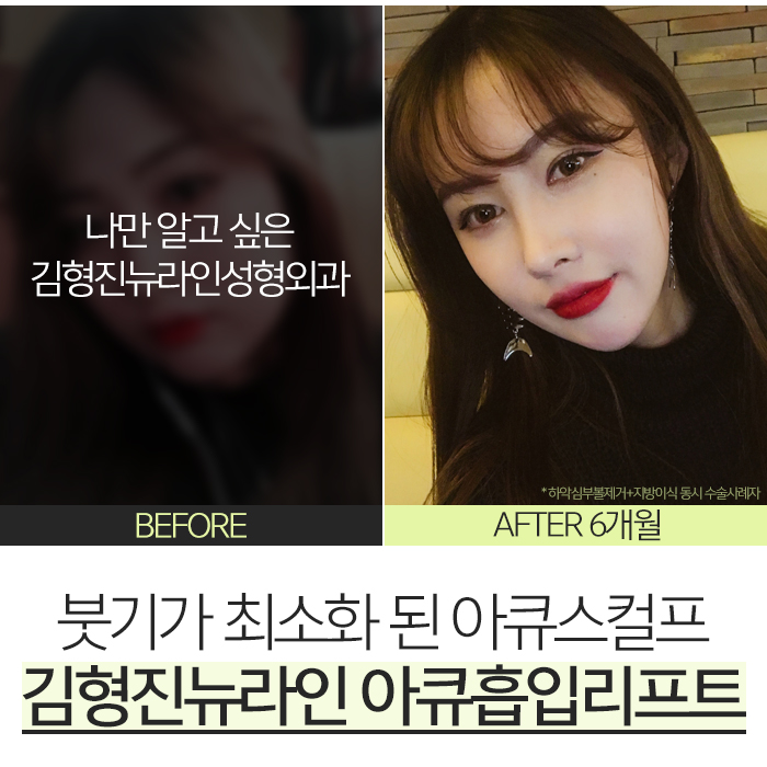 얼굴아큐스컬프 안 할 이유가 없죠 관련 이미지 2