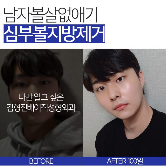 남자볼살없애기 실패한 이유, 아직 몰라요? 관련 이미지 4