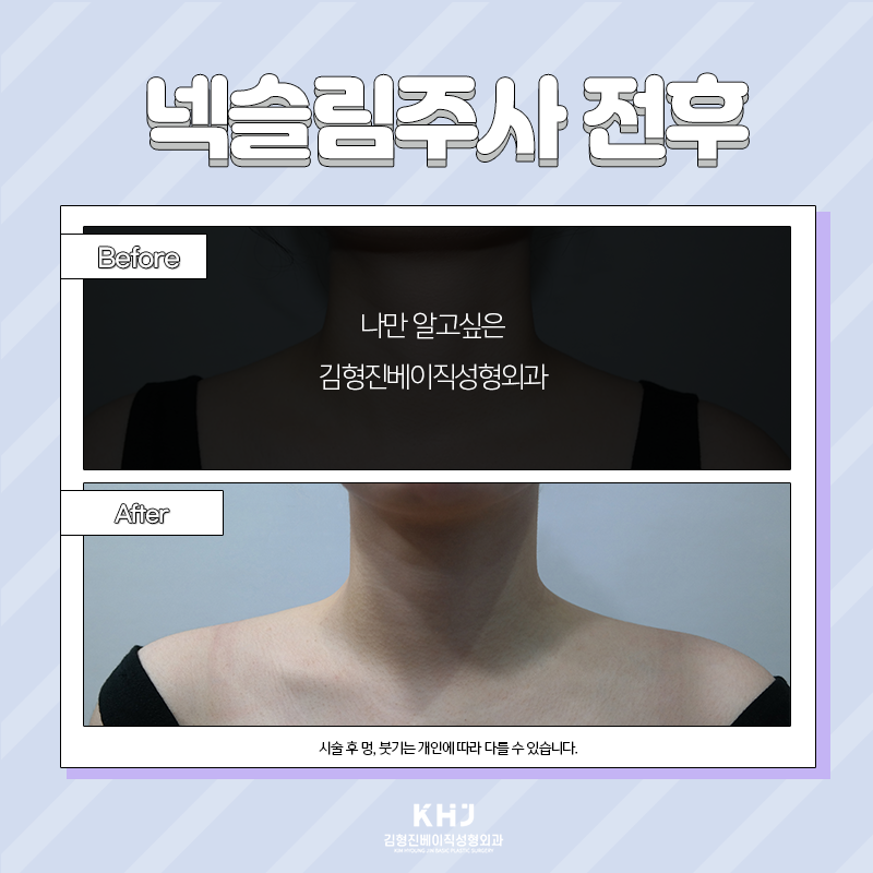 넥슬림주사전후 당연히 보여드려야죠! 관련 이미지 3