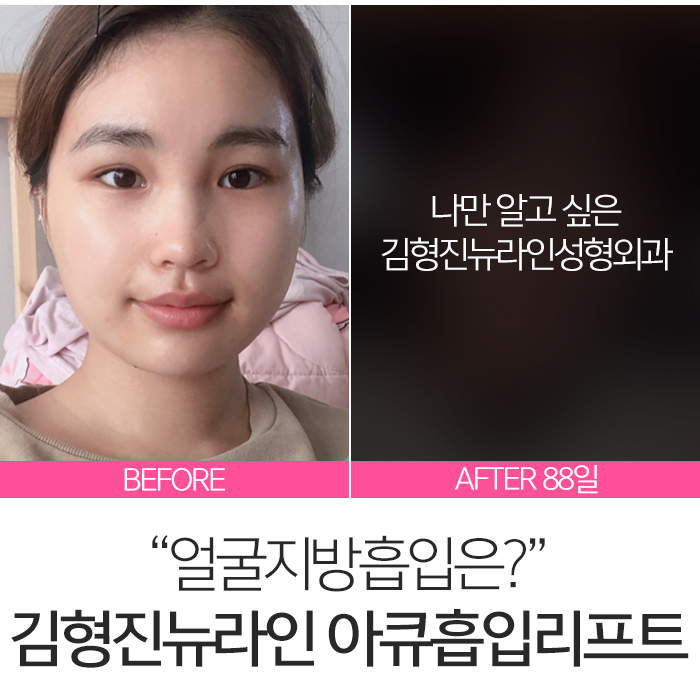 얼굴아큐스컬프 살빼는데 최고죠 관련 이미지 3