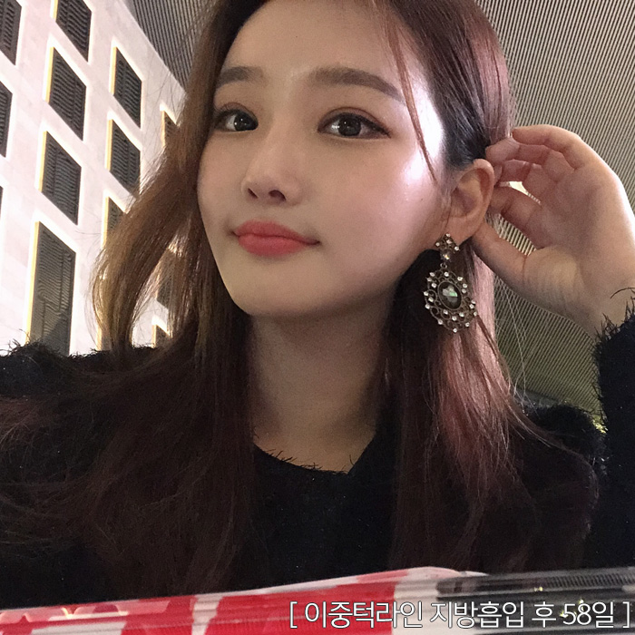 턱지방분해주사 효과 못 보지 않았어요? 관련 이미지 4