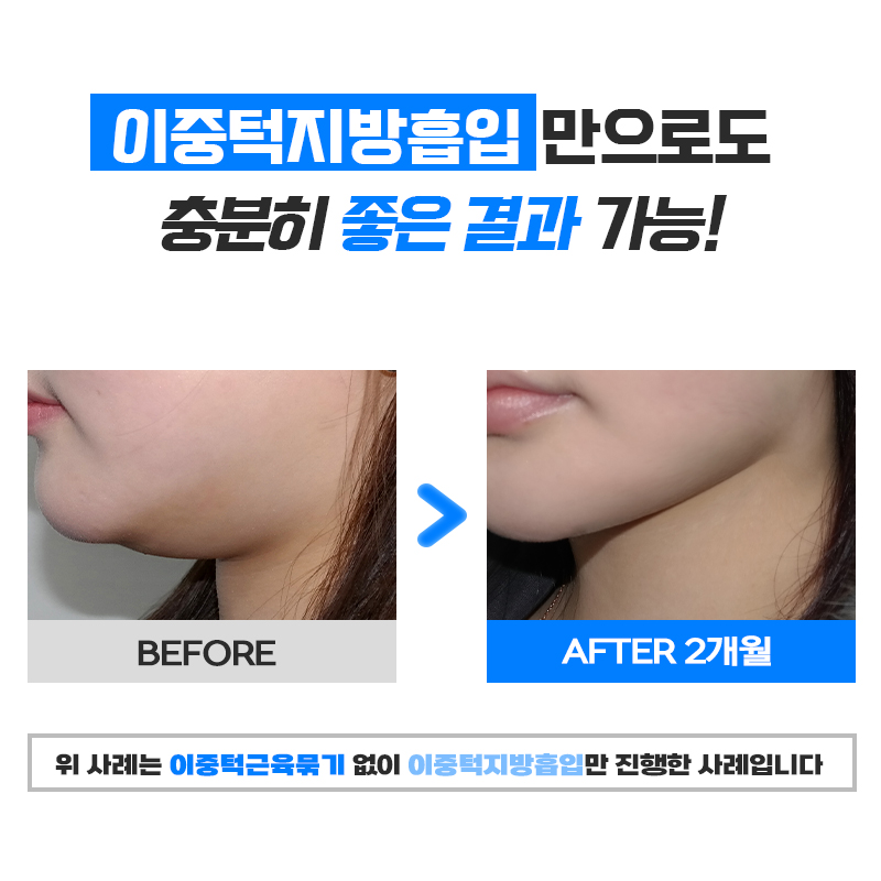 I Decided Without Hesitation at a Clinic Known for Effective Double-Chin Liposuction image 6