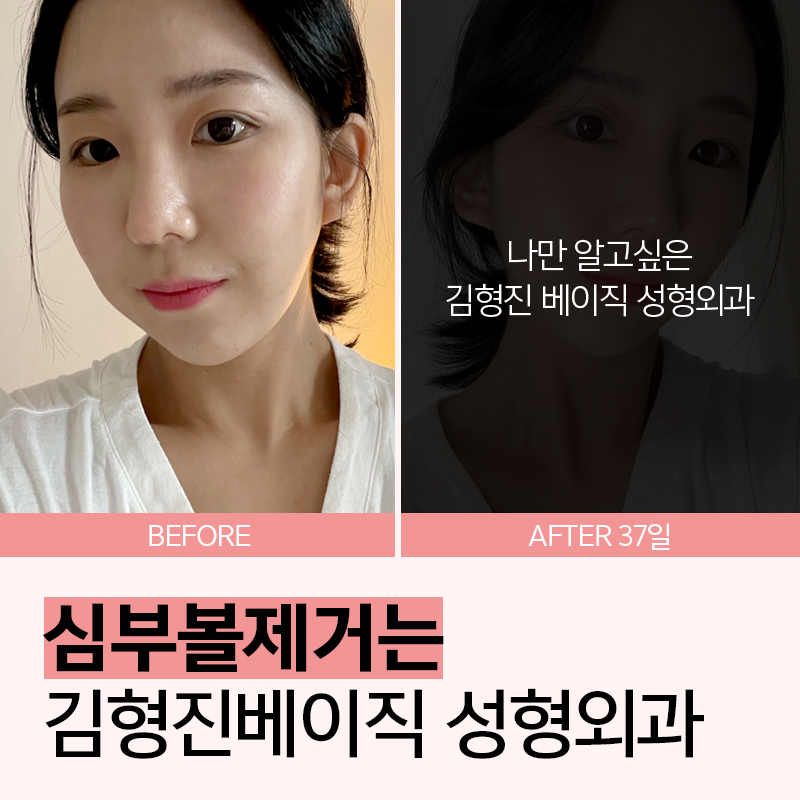 심부볼지방제거수술로 처진 불독살 개선 끝 관련 이미지 3