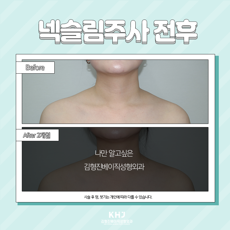 두꺼운목 해결방법 여기 있어요! 관련 이미지 4