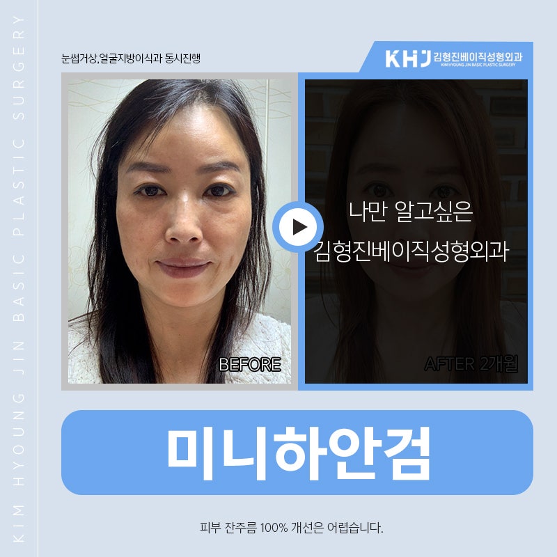 미니하안검붓기 걱정하지마세요! 관련 이미지 4