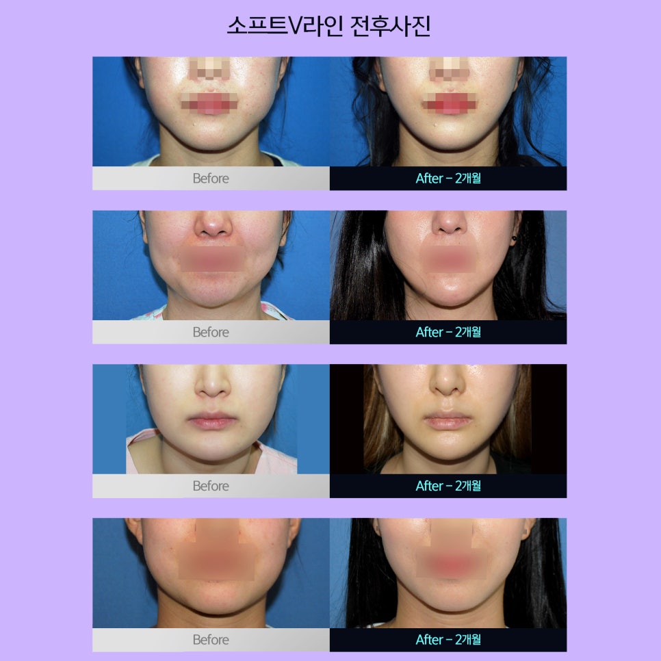 얼굴지방제거로 만드는 세련된 브이라인 관련 이미지 6