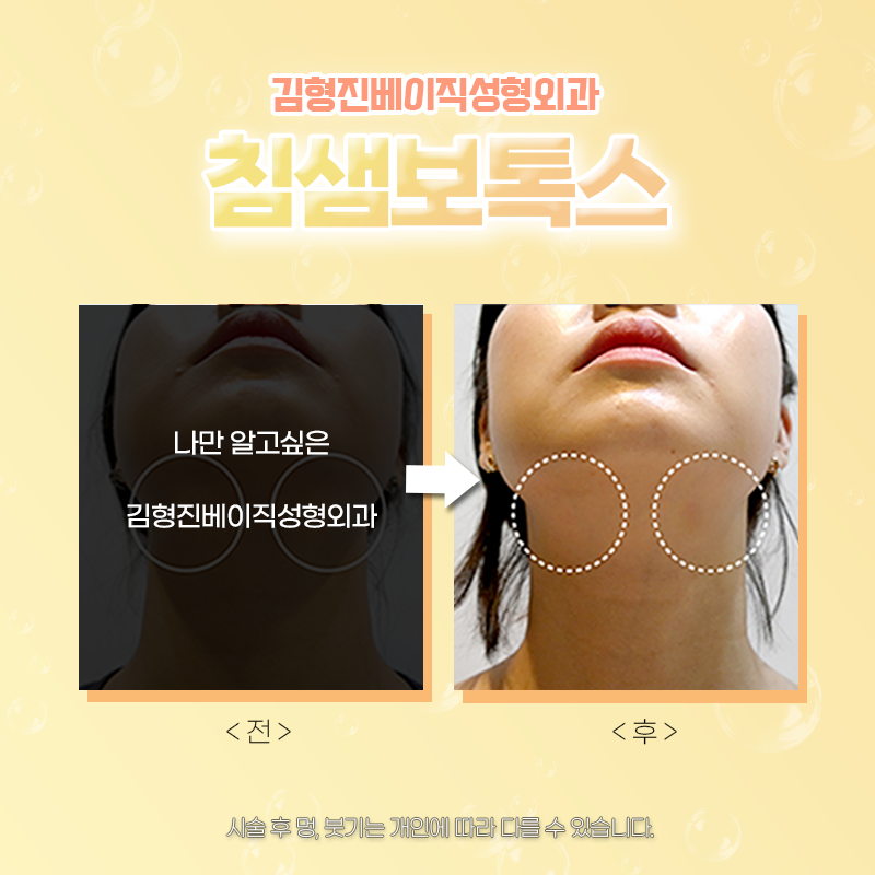 침샘비대증치료 김형진베이직에서 하셔야죠! 관련 이미지 4