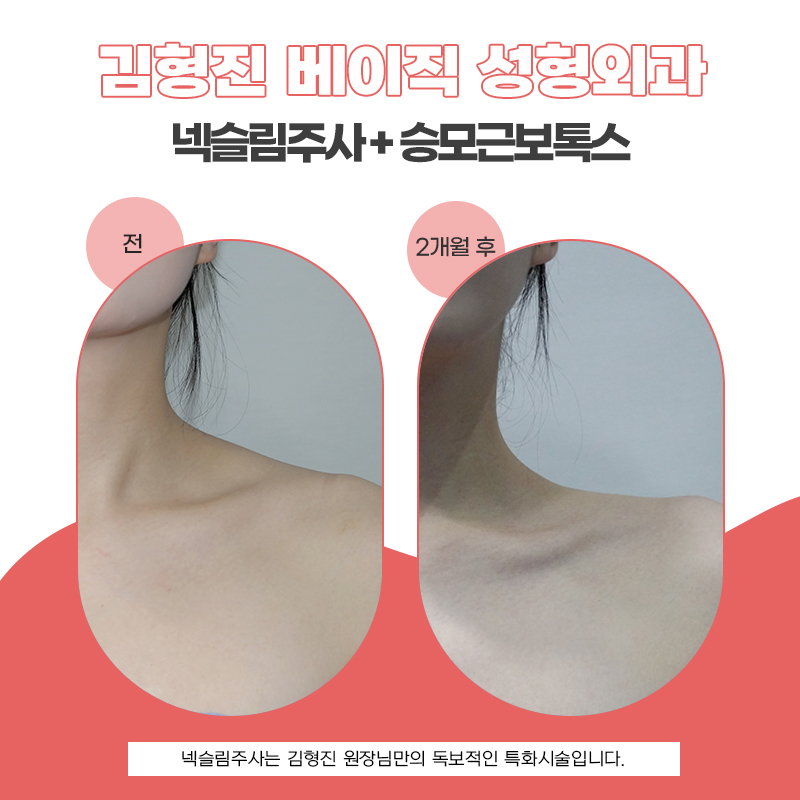 넥슬림주사시술로 한층 가벼워진 목선, 자신감이 달라졌어요 관련 이미지 5