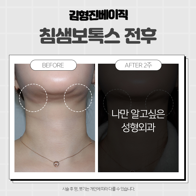 압구정침샘보톡스 맛집 찾아버렸습니다ㅠㅠ 관련 이미지 5