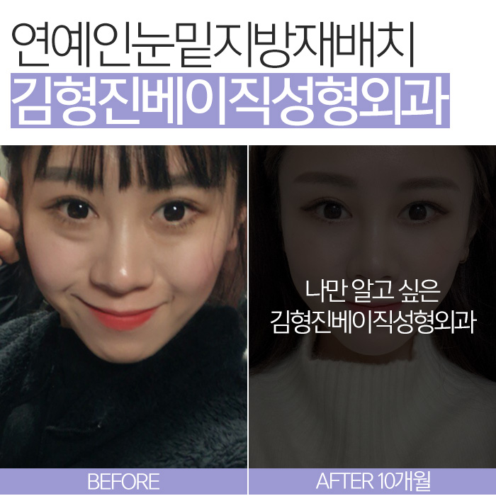 연예인눈밑지방재배치 이런 거구나 관련 이미지 2