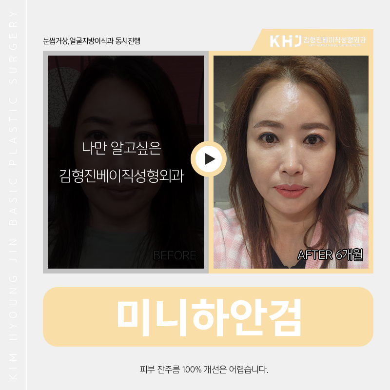 미니하안검흉터 걱정은 이제 그만~! 관련 이미지 4